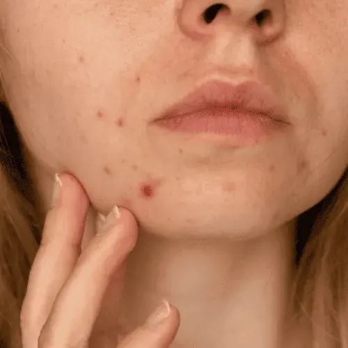 Breakouts & Adult Acne