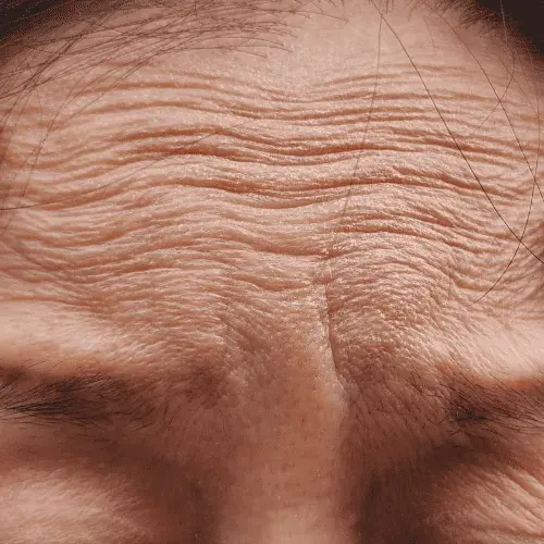 Fine Lines & Wrinkles