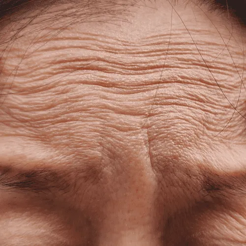 Fine Lines & Wrinkles